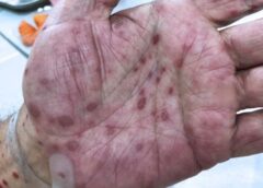 SÍFILIS CONTINUA EM RITMO ACELERADO DE CRESCIMENTO NO PAÍS