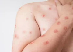 BRASIL REGISTRA 88 CASOS DE MPOX EM 2026