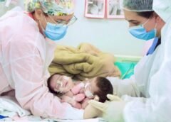 GÊMEAS SIAMESAS NASCIDAS NO AM COMPLETAM 1 ANO APÓS CIRURGIA DE SEPARAÇÃO BEM-SUCEDIDA